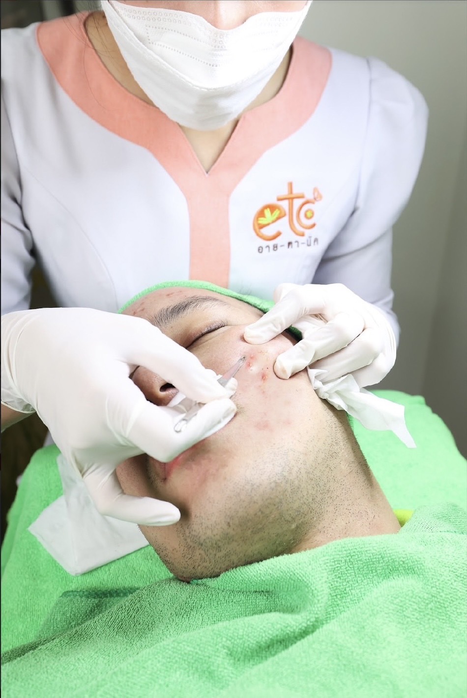 Acne extraction pictures